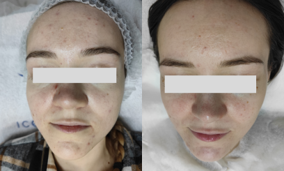 Авторский пилинг Себорегулирующий